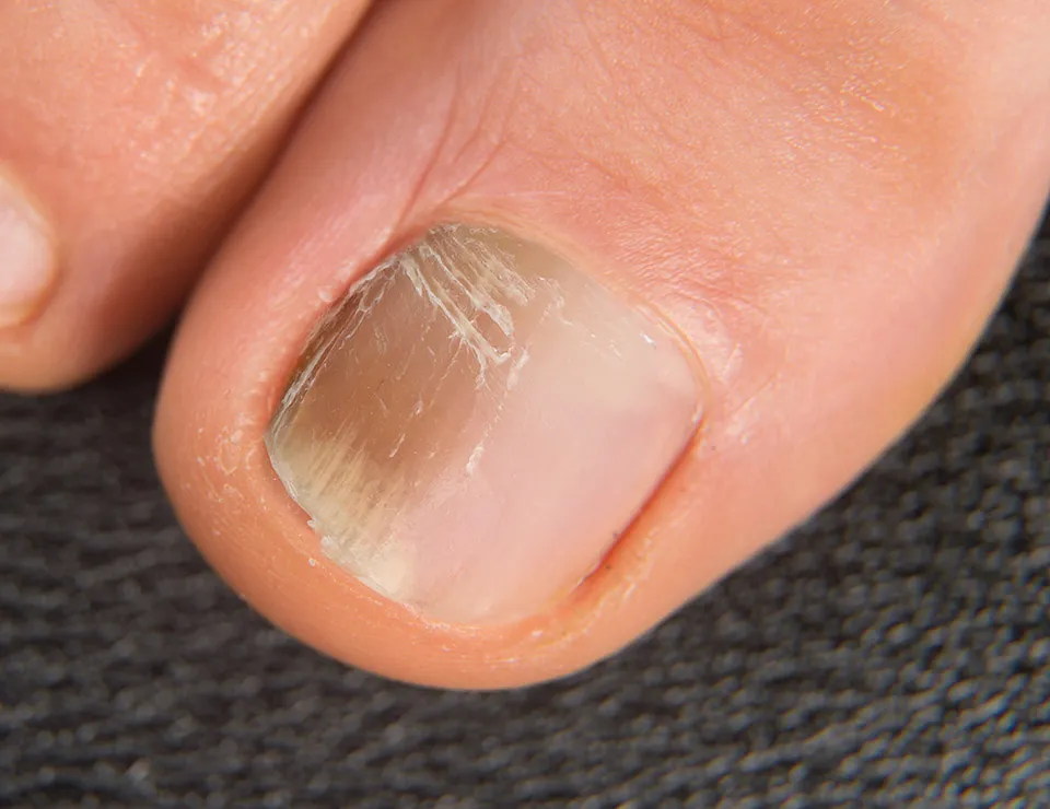 toenail before