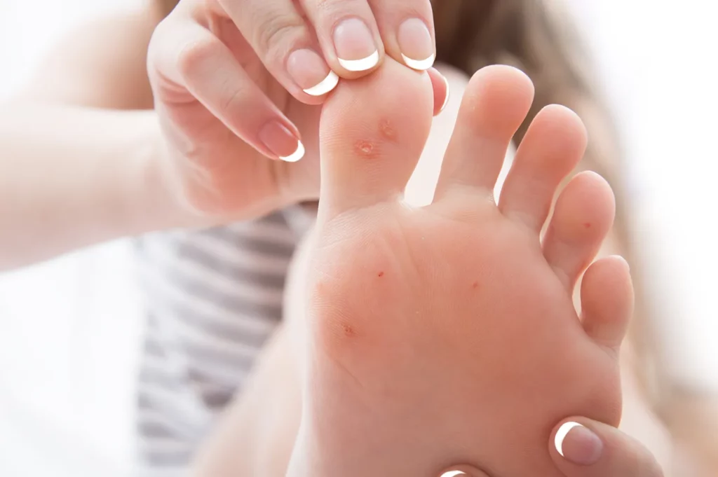 Reliable Warts Treatment in San Francisco, CA