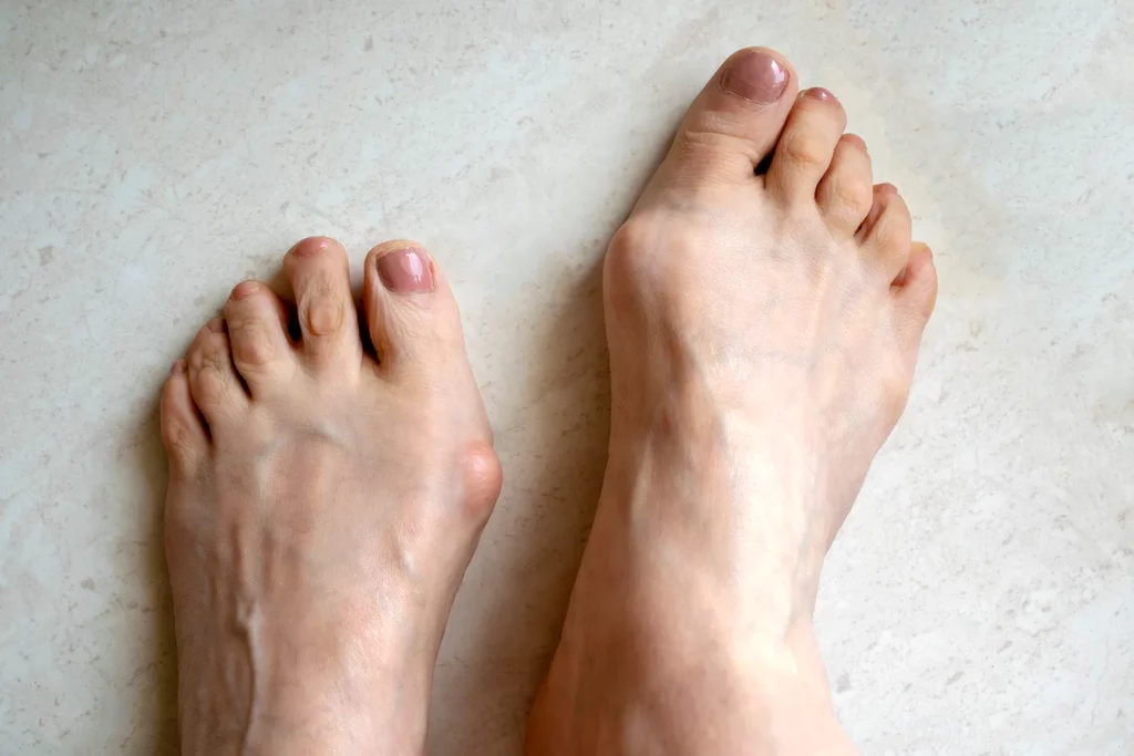 Expert Bunion Treatment in San Francisco, CA