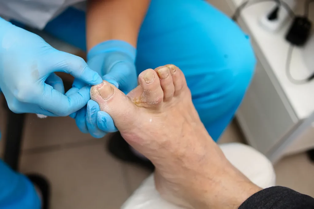 Expert Toenail Fungus Treatment in San Francisco, CA