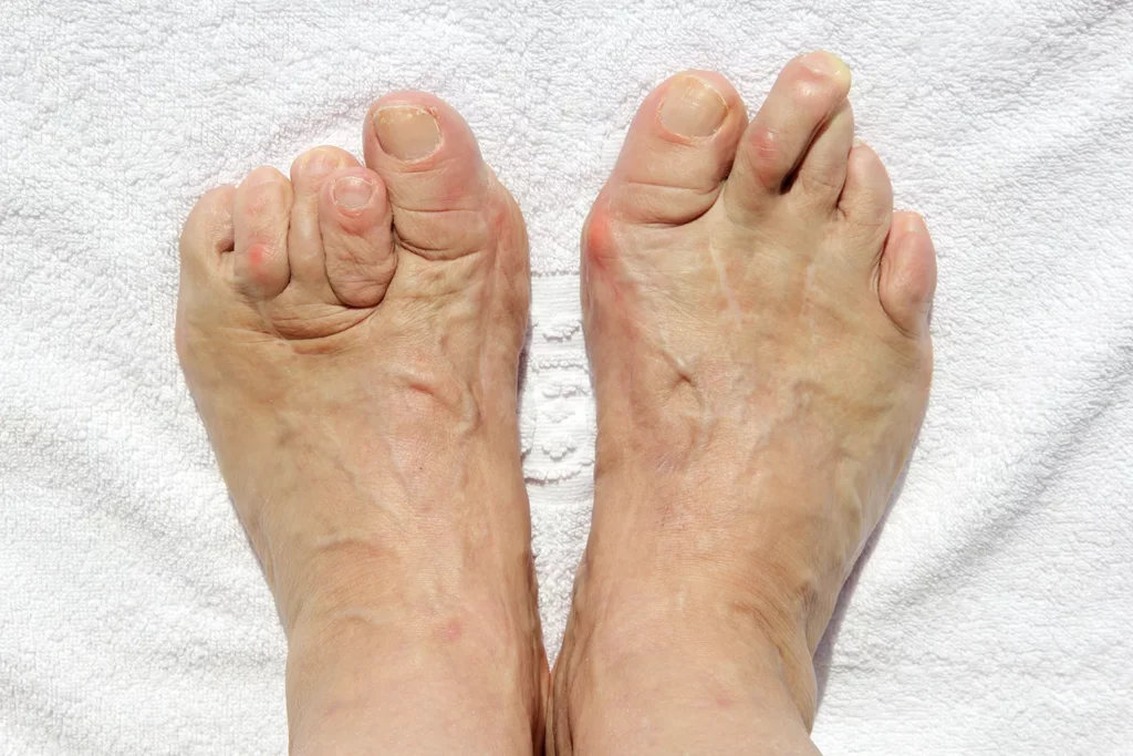 Quality Hammertoes Treatment in San Francisco, CA