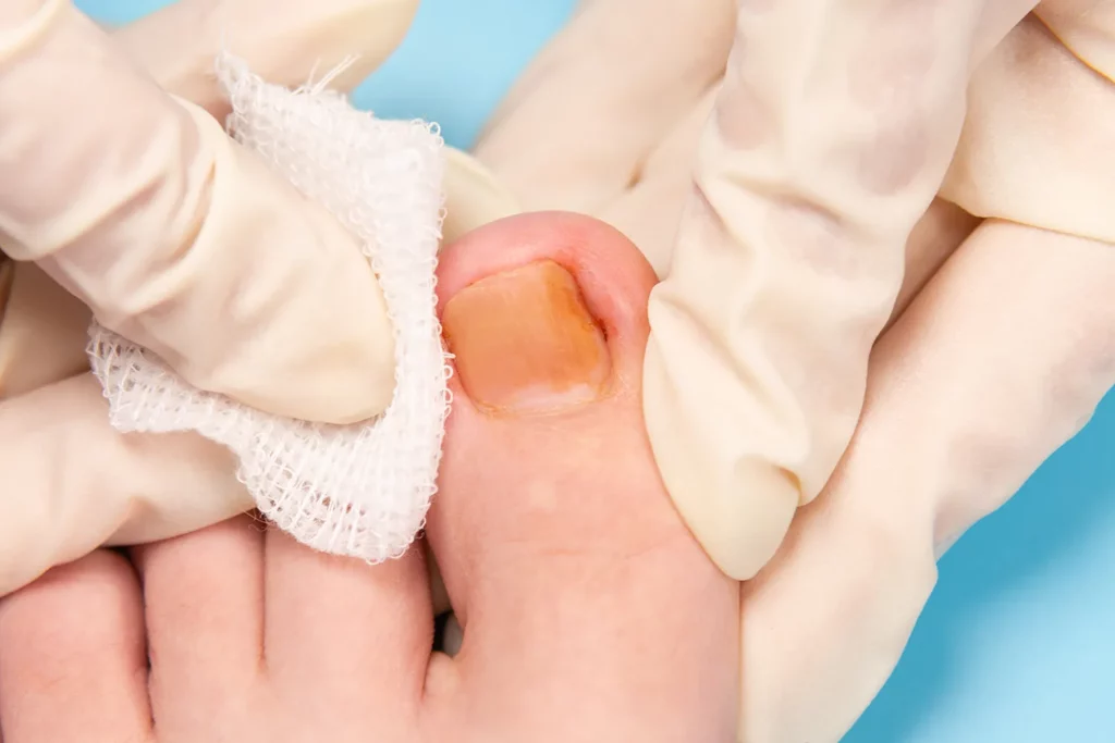 Ingrown Toenails Treatment in San Francisco, CA