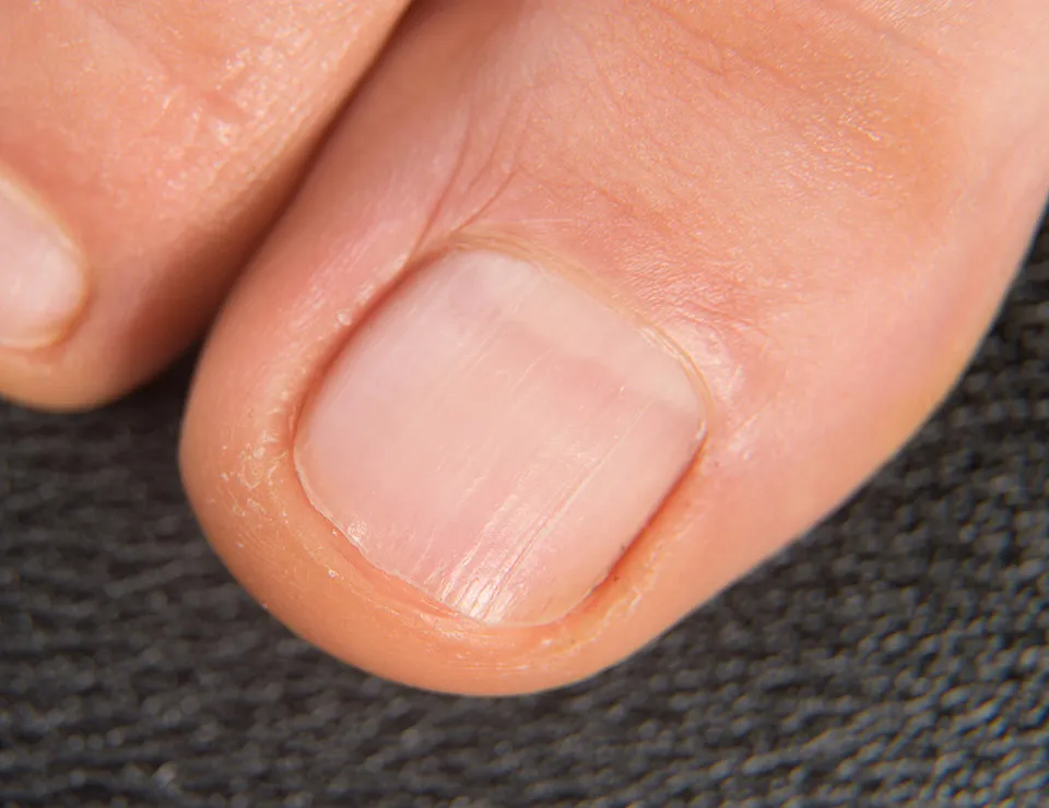 toenail after toenail after