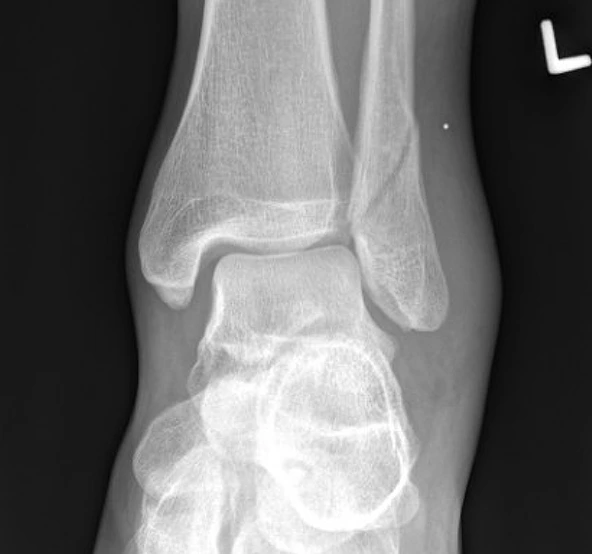 Foot Fractures and Trauma Treatment in San Francisco, CA