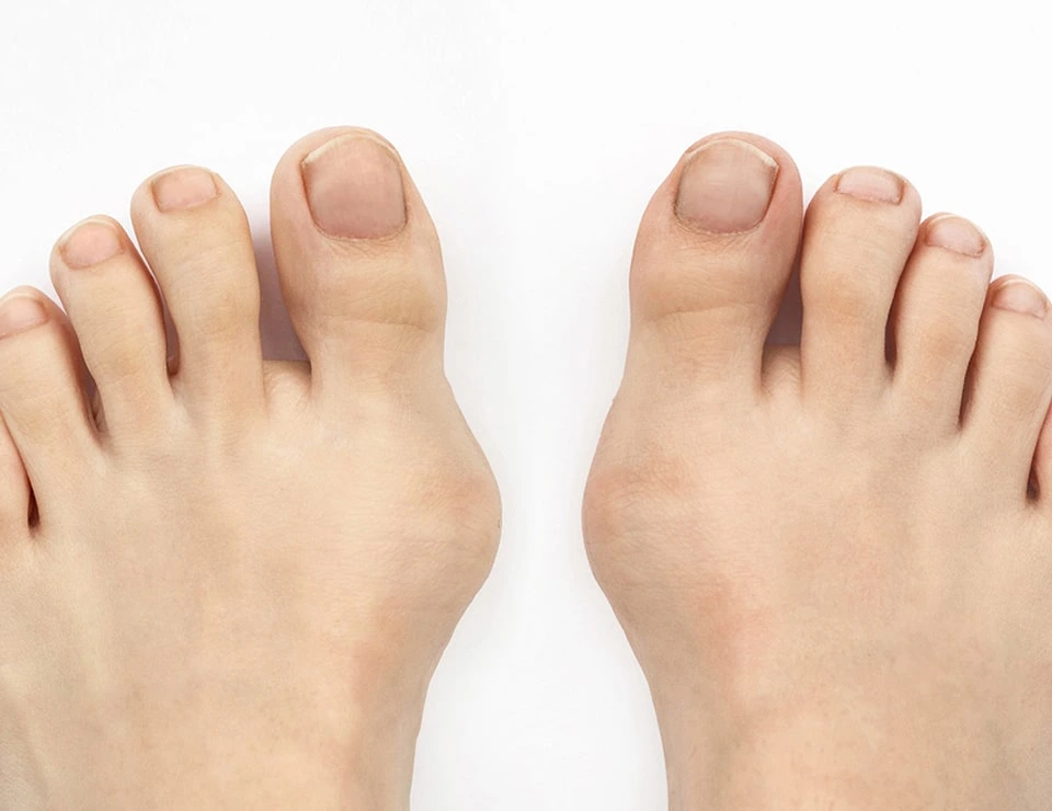 Bunion Before Bunion Before