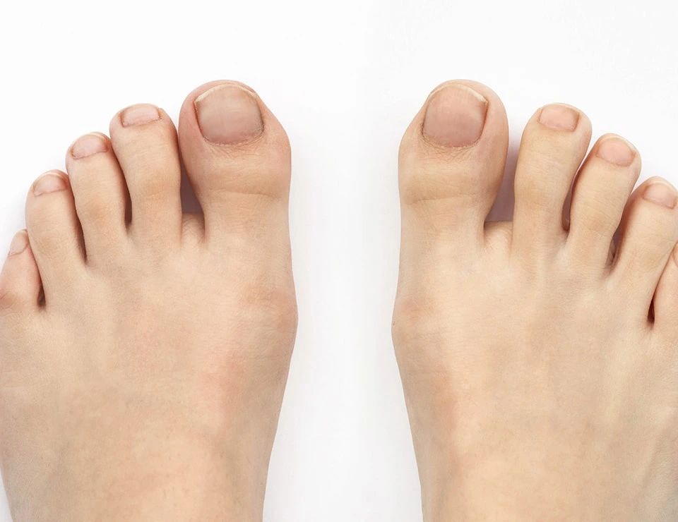 Bunion After Bunion After