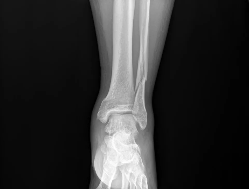 Bone Fracture Before Bone Fracture Before