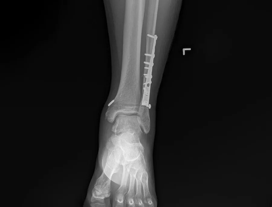 Bone Fracture After Bone Fracture After